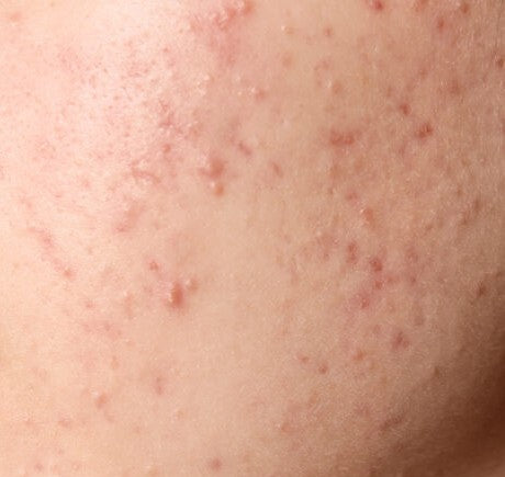 Acne Scars & Imperfections